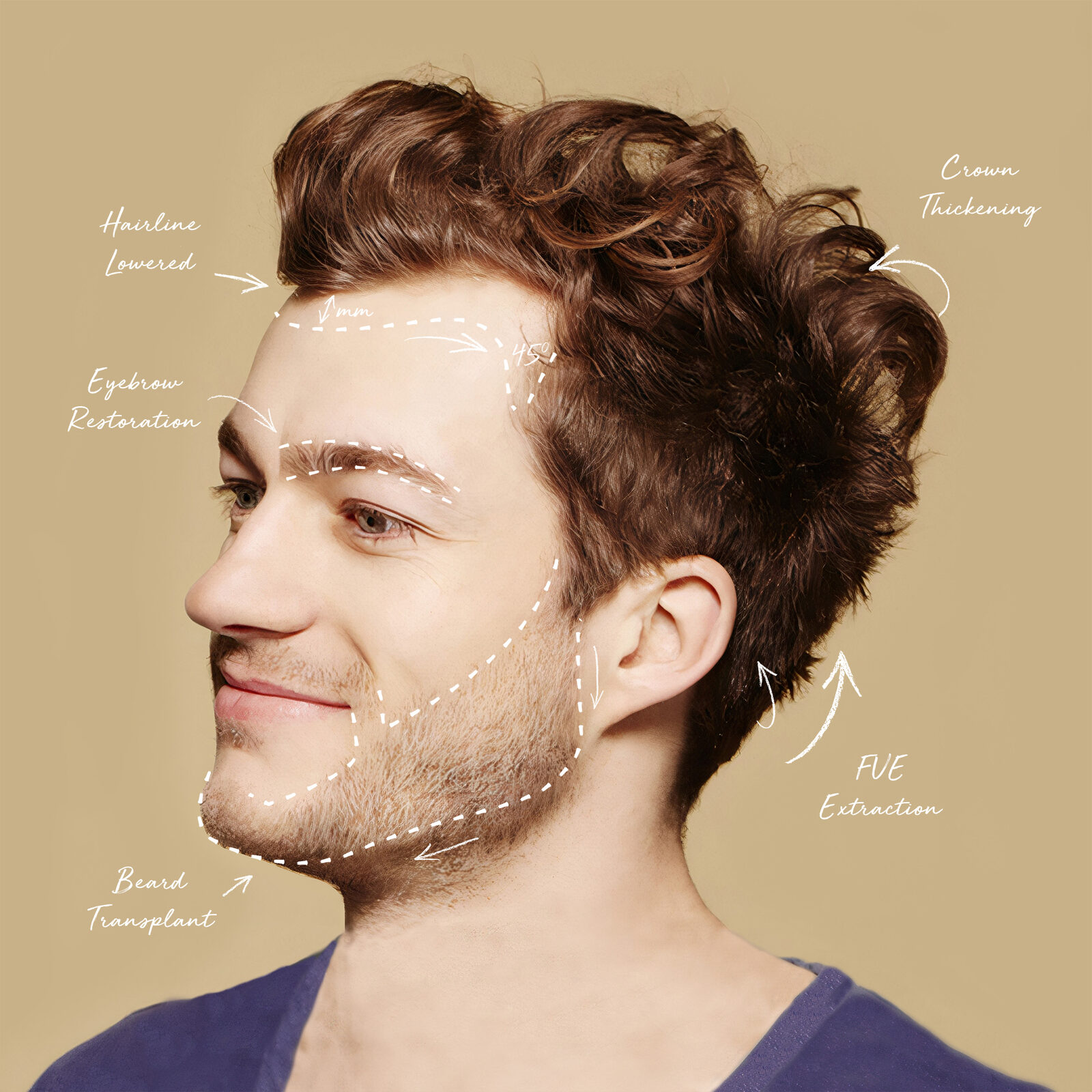 FUE Clinics hair transplant patient result
